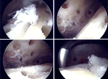 Arthroskopisch durchgeführte Versteifungsoperation des oberen Sprunggelenkes, das Gelenkinnere wird aufgerauht und angebohrt